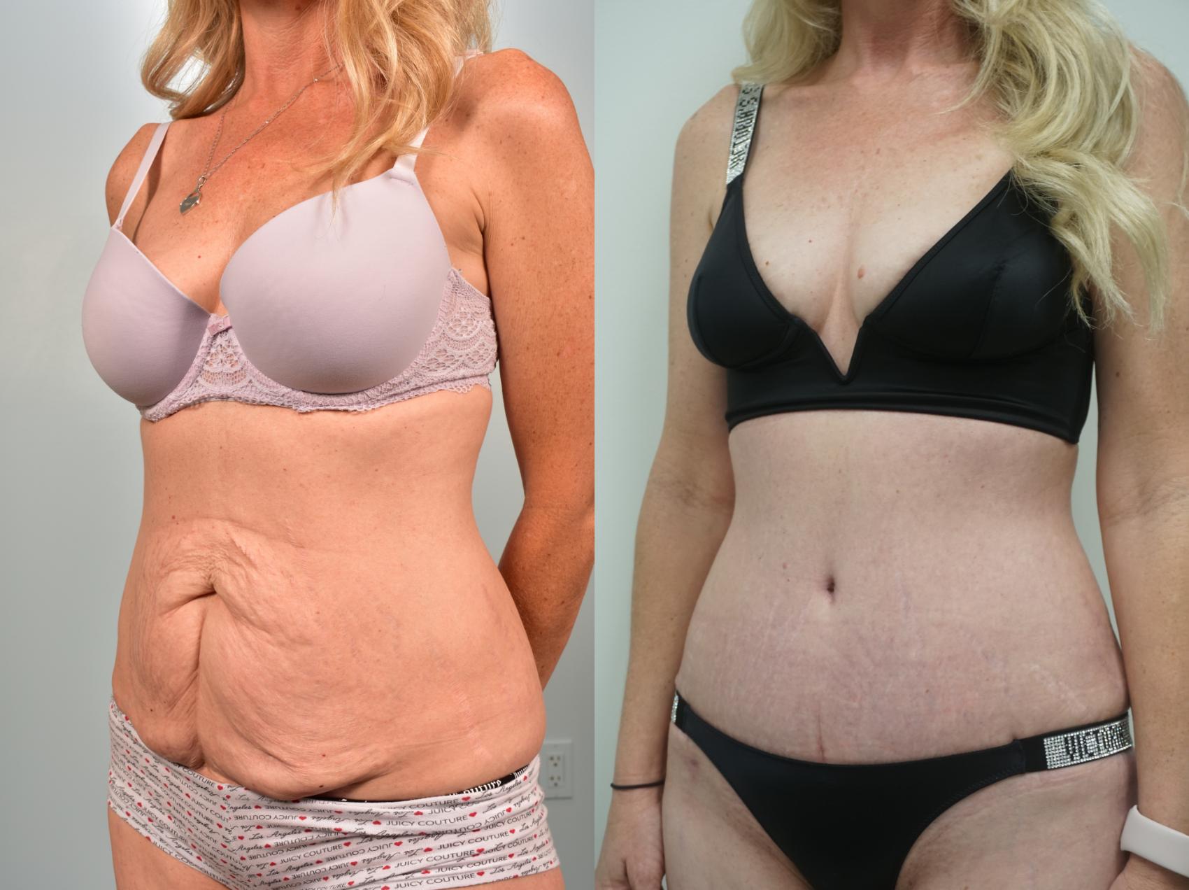 Before & After Tummy Tuck (Abdominoplasty) Case 328 Left Oblique View in Gilbert, AZ