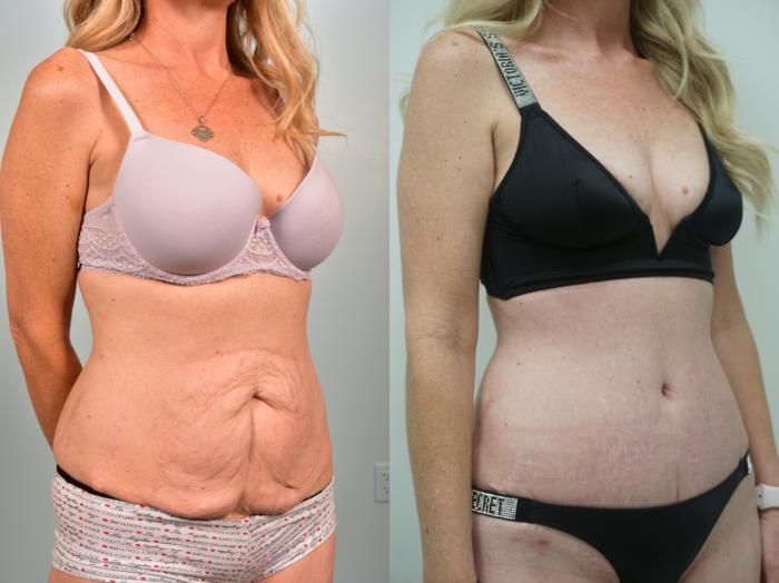Before & After Tummy Tuck (Abdominoplasty) Case 328 Right Oblique View in Gilbert, AZ
