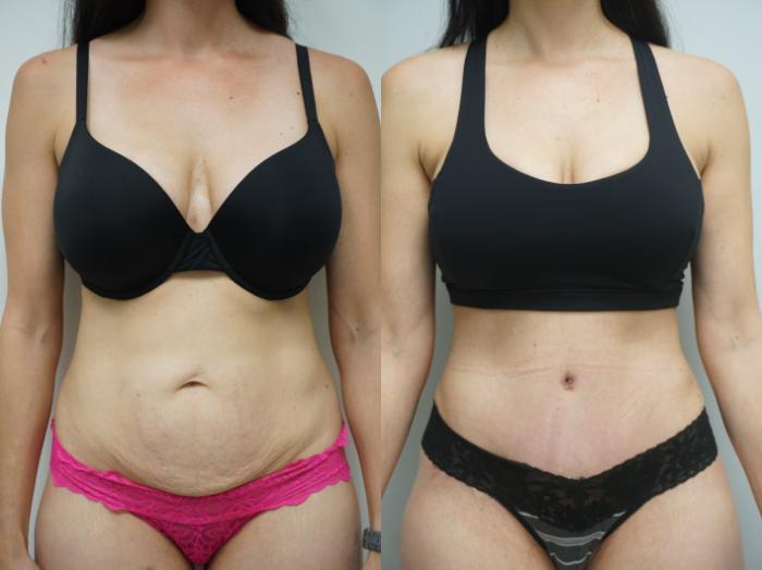 Before & After Tummy Tuck (Abdominoplasty) Case 335 Front View in Gilbert, AZ
