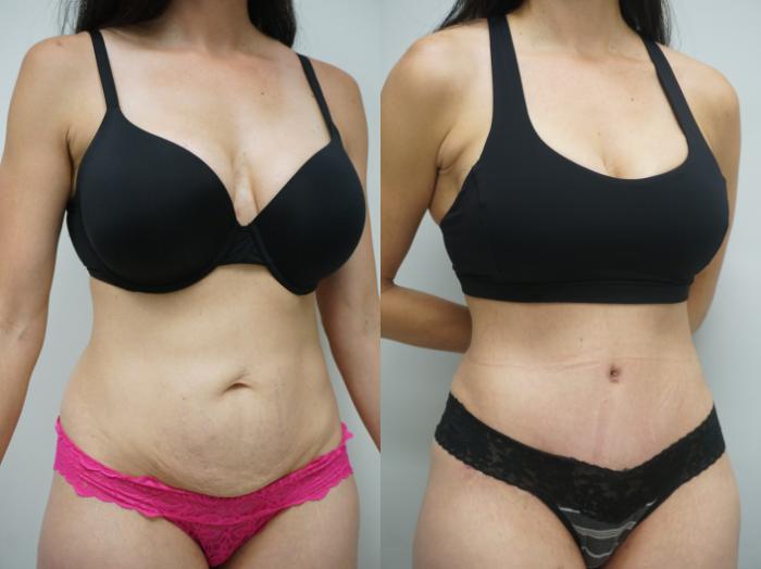 Before & After Tummy Tuck (Abdominoplasty) Case 335 Left Oblique View in Gilbert, AZ