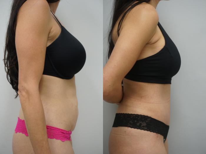 Before & After Tummy Tuck (Abdominoplasty) Case 335 Left Side View in Gilbert, AZ
