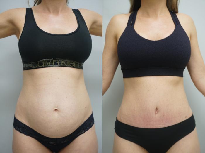 Before & After Tummy Tuck (Abdominoplasty) Case 337 Front View in Gilbert, AZ