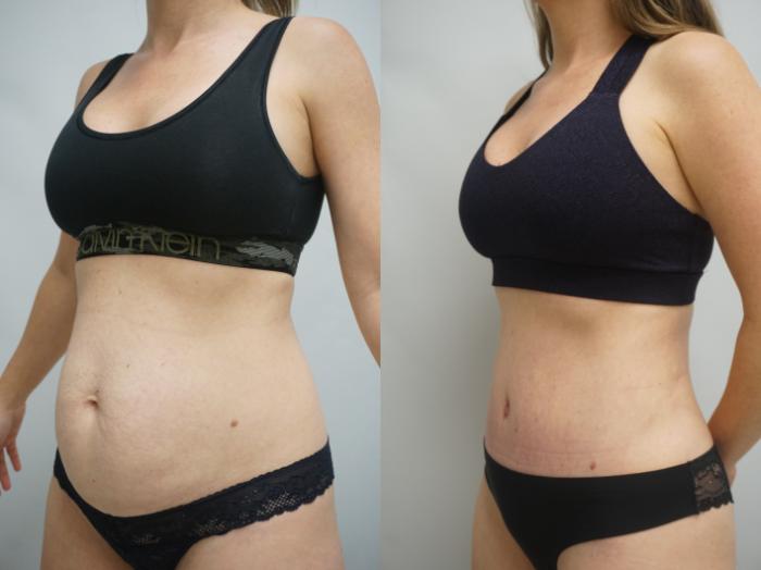 Before & After Tummy Tuck (Abdominoplasty) Case 337 Left Oblique View in Gilbert, AZ