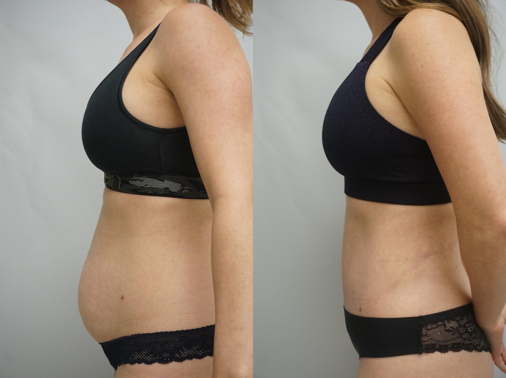 Before & After Tummy Tuck (Abdominoplasty) Case 337 Left Side View in Gilbert, AZ