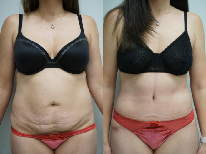 Before & After Tummy Tuck (Abdominoplasty) Case 340 Front View in Gilbert, AZ