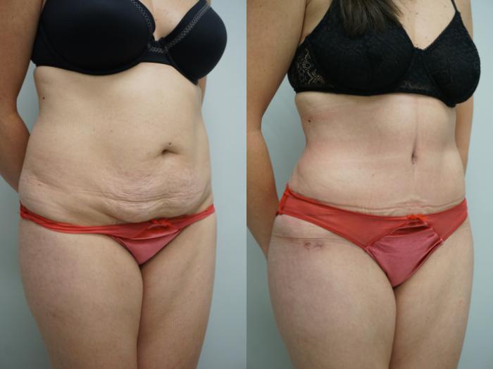 Before & After Tummy Tuck (Abdominoplasty) Case 340 Left Oblique View in Gilbert, AZ