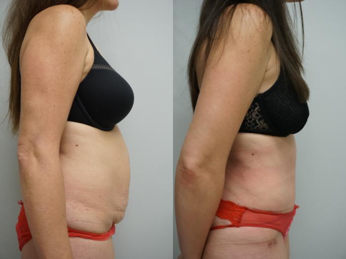 Before & After Tummy Tuck (Abdominoplasty) Case 340 Right Side View in Gilbert, AZ