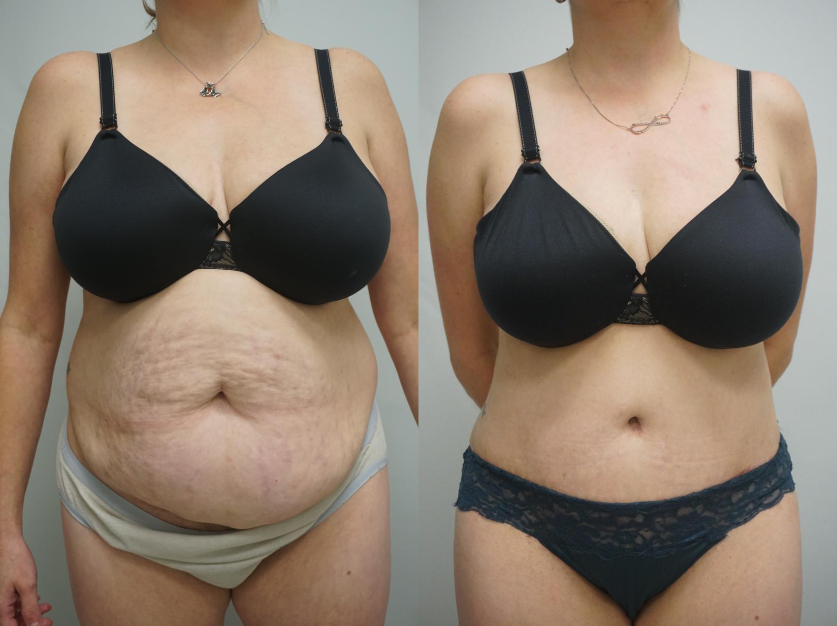 Before & After Tummy Tuck (Abdominoplasty) Case 341 Front View in Gilbert, AZ
