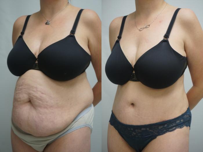 Before & After Tummy Tuck (Abdominoplasty) Case 341 Left Oblique View in Gilbert, AZ