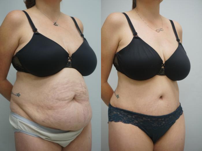 Before & After Tummy Tuck (Abdominoplasty) Case 341 Right Oblique View in Gilbert, AZ