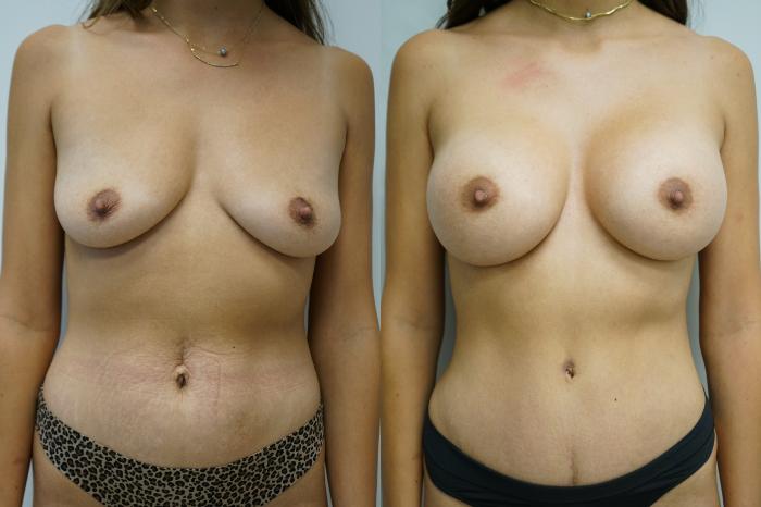 Before & After Breast Augmentation Case 350 Front View in Gilbert, AZ