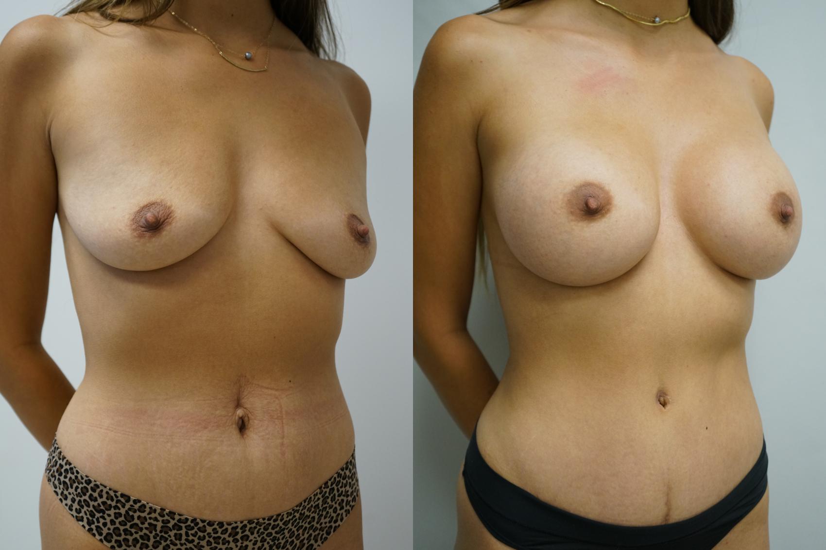 Before & After Breast Augmentation Case 350 Right Oblique View in Gilbert, AZ