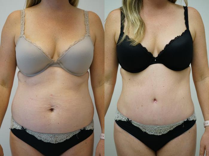 Before & After Liposuction Case 366 Front View in Gilbert, AZ