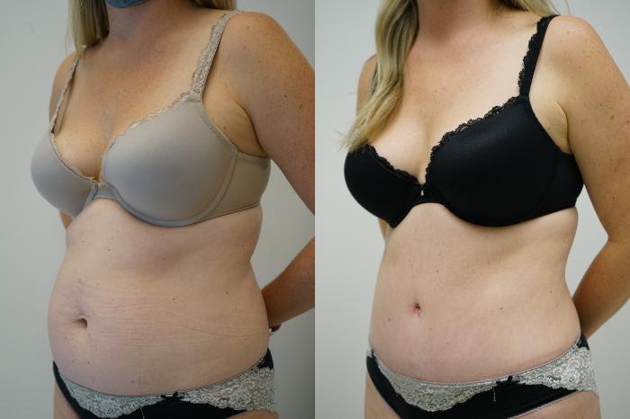 Before & After Tummy Tuck (Abdominoplasty) Case 366 Left Oblique View in Gilbert, AZ