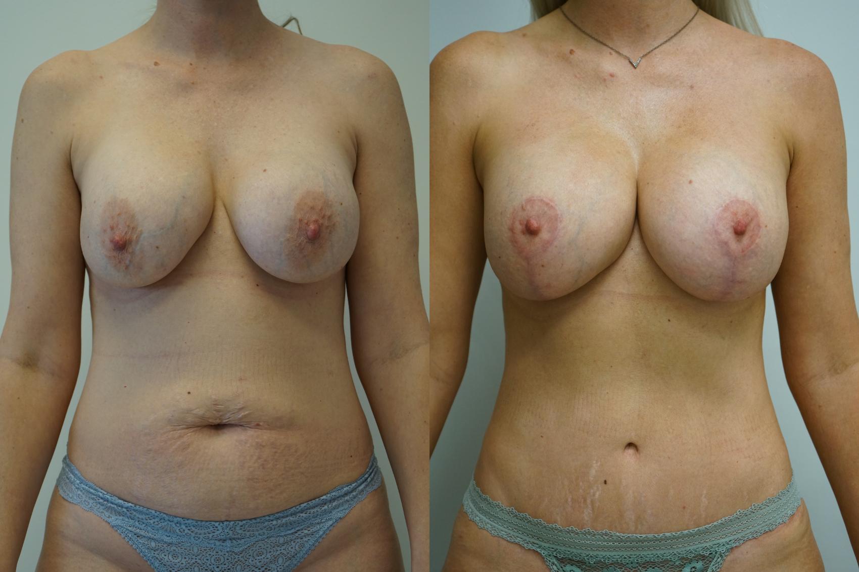Before & After Liposuction Case 372 Front View in Gilbert, AZ