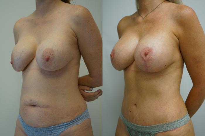 Before & After Breast Augmentation with Breast Lift  Case 372 Left Oblique View in Gilbert, AZ