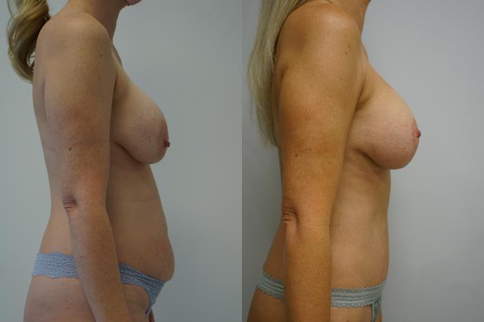 Before & After Breast Augmentation with Breast Lift  Case 372 Right Side View in Gilbert, AZ