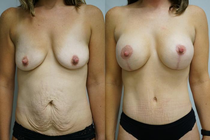 Before & After Liposuction Case 374 Front View in Gilbert, AZ