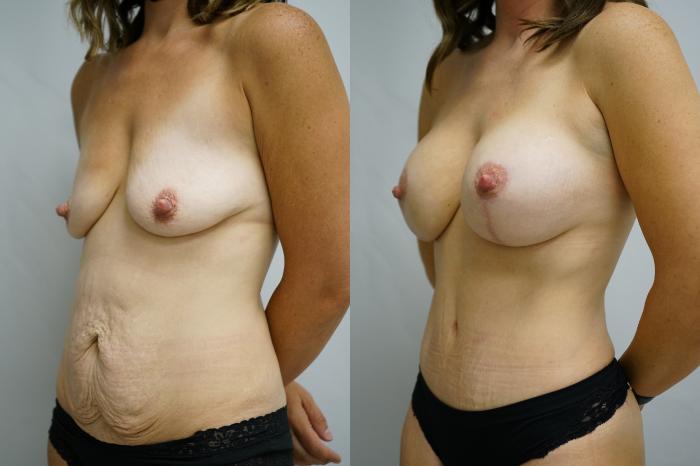 Before & After Breast Augmentation with Breast Lift  Case 374 Left Oblique View in Gilbert, AZ