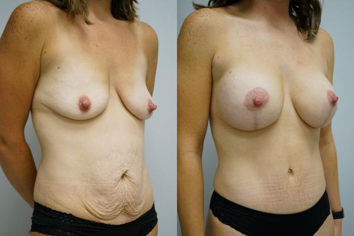 Before & After Breast Augmentation with Breast Lift  Case 374 Right Oblique View in Gilbert, AZ