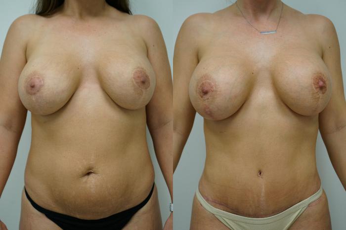 Before & After Breast Implant Exchange Case 382 Front View in Gilbert, AZ