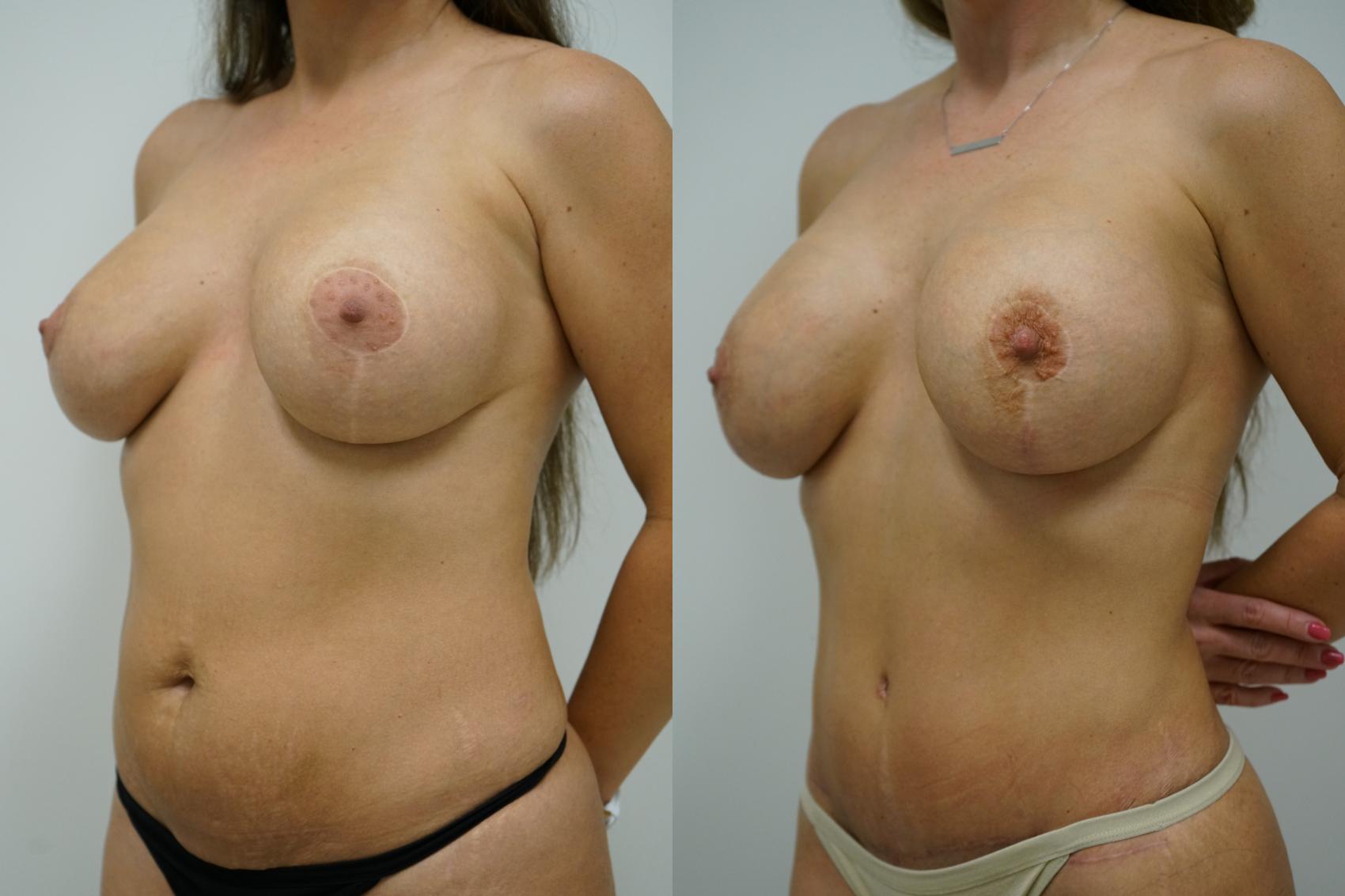Before & After Abdominoplasty (Tummy Tuck) Case 382 Left Oblique View in Gilbert, AZ