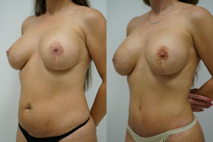 Before & After Tummy Tuck (Abdominoplasty) Case 382 Left Oblique View in Gilbert, AZ