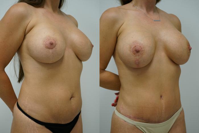 Before & After Tummy Tuck (Abdominoplasty) Case 382 Right Oblique View in Gilbert, AZ