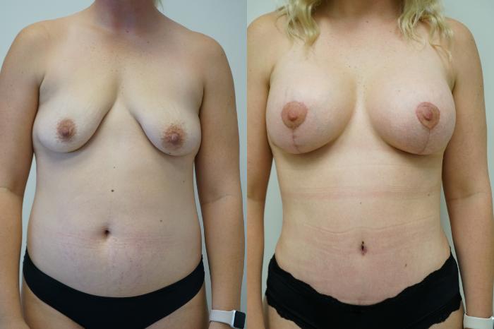 Before & After Breast Augmentation with Breast Lift  Case 384 Front View in Gilbert, AZ