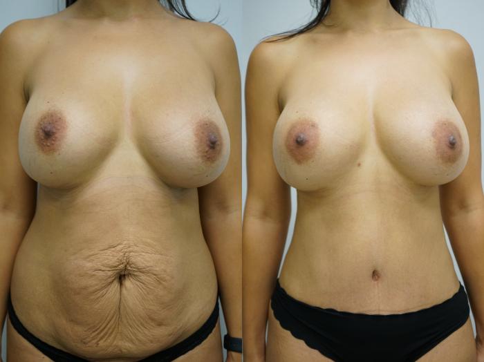 Before & After Tummy Tuck (Abdominoplasty) Case 388 Front View in Gilbert, AZ
