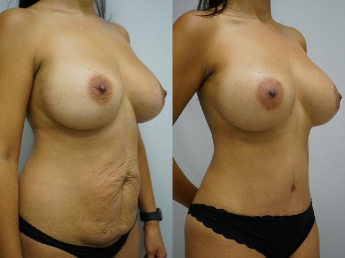 Before & After Tummy Tuck (Abdominoplasty) Case 388 Right Oblique View in Gilbert, AZ