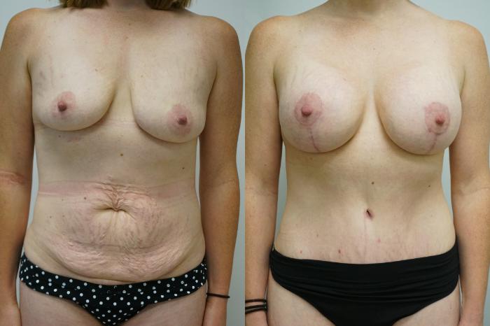 Before & After Breast Augmentation with Breast Lift  Case 390 Front View in Gilbert, AZ