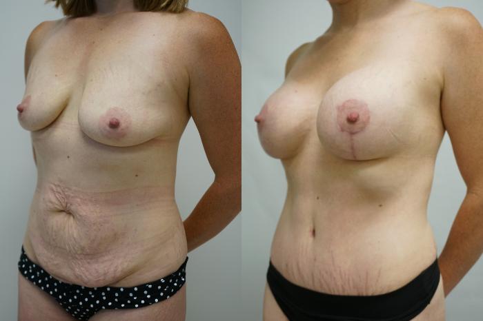 Before & After Breast Augmentation with Breast Lift  Case 390 Left Oblique View in Gilbert, AZ