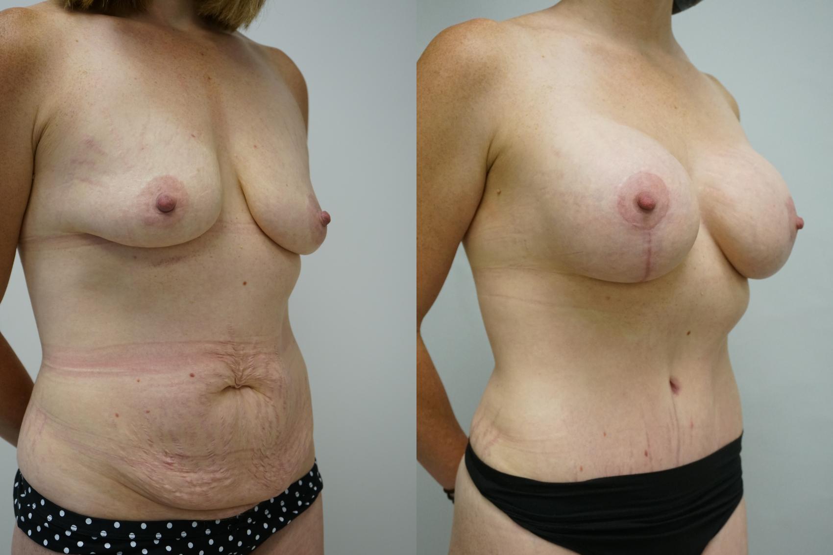 Before & After Abdominoplasty (Tummy Tuck) Case 390 Right Oblique View in Gilbert, AZ