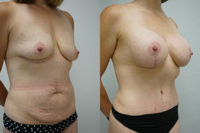 Before & After Breast Augmentation with Breast Lift  Case 390 Right Oblique View in Gilbert, AZ