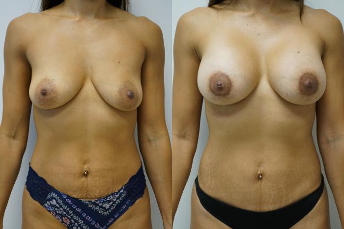 Before & After Breast Augmentation Case 391 Front View in Gilbert, AZ