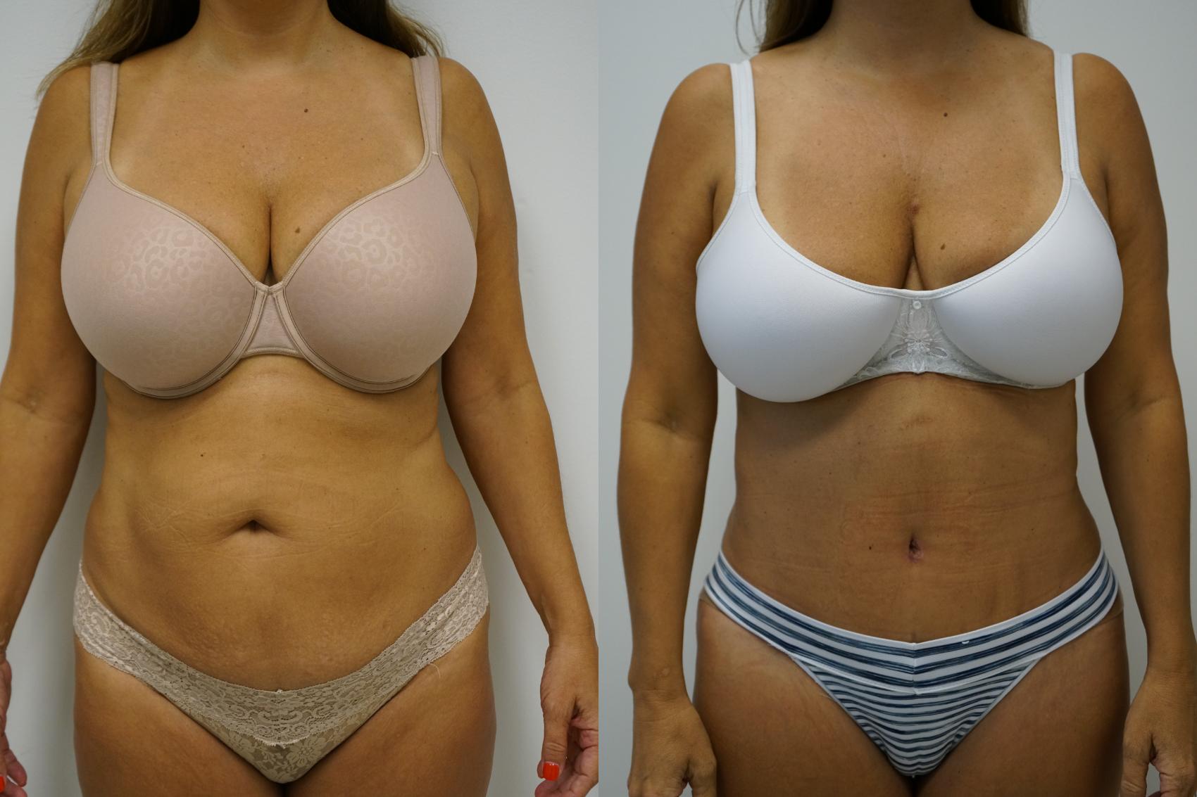 Before & After Tummy Tuck (Abdominoplasty) Case 394 Front View in Gilbert, AZ
