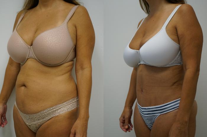 Before & After Tummy Tuck (Abdominoplasty) Case 394 Left Oblique View in Gilbert, AZ