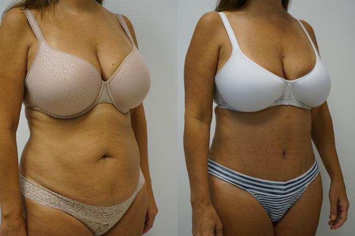 Before & After Tummy Tuck (Abdominoplasty) Case 394 Right Oblique View in Gilbert, AZ