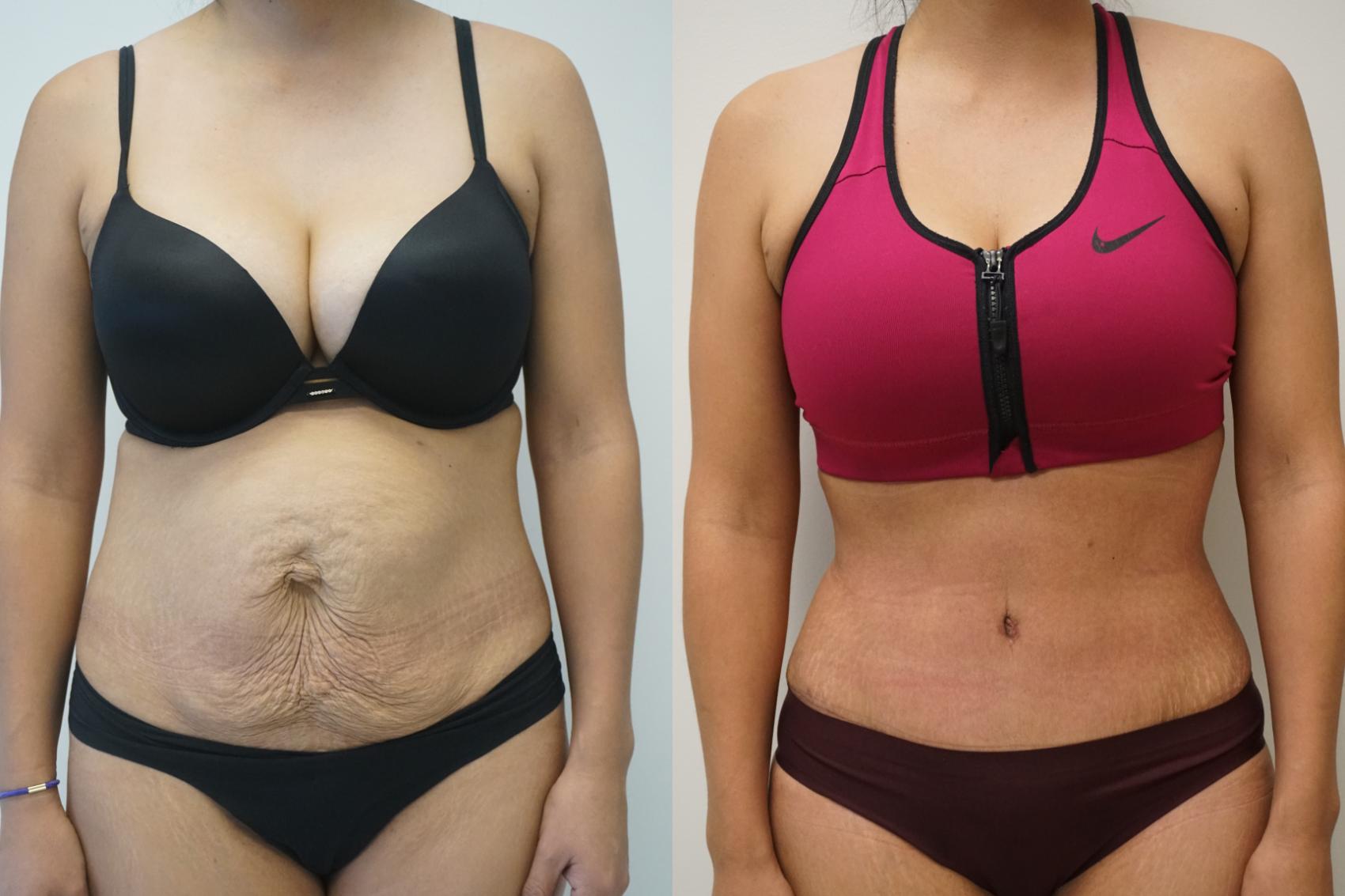 Before & After Tummy Tuck (Abdominoplasty) Case 417 Front View in Gilbert, AZ