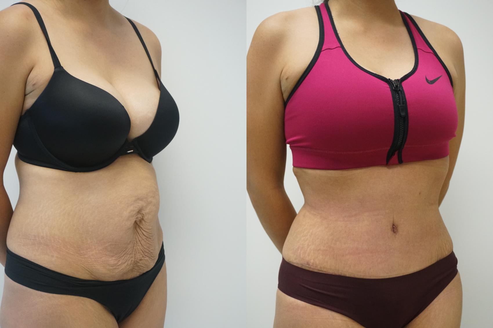 Before & After Abdominoplasty (Tummy Tuck) Case 417 Right Oblique View in Gilbert, AZ