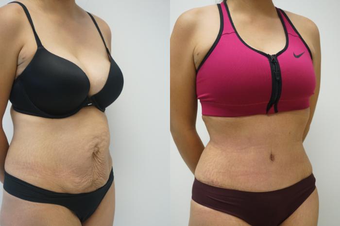 Before & After Tummy Tuck (Abdominoplasty) Case 417 Right Oblique View in Gilbert, AZ