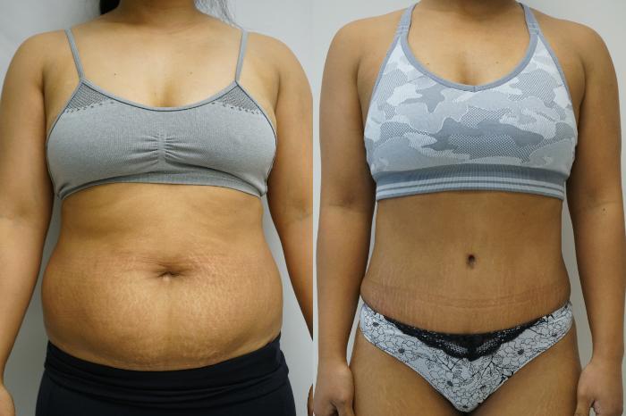 Before & After Tummy Tuck (Abdominoplasty) Case 428 Front View in Gilbert, AZ