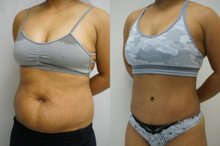 Before & After Tummy Tuck (Abdominoplasty) Case 428 Left Oblique View in Gilbert, AZ