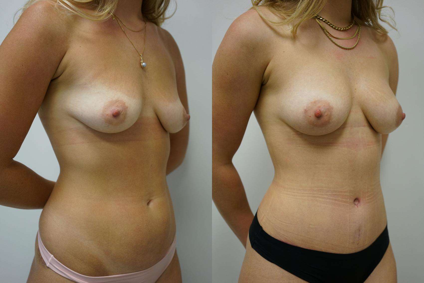 Before & After Abdominoplasty (Tummy Tuck) Case 443 Right Oblique View in Gilbert, AZ