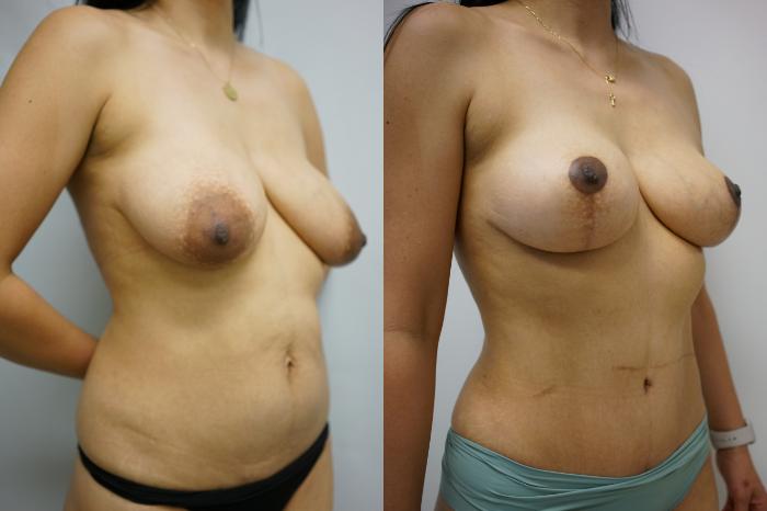 Before & After Tummy Tuck (Abdominoplasty) Case 444 Right Oblique View in Gilbert, AZ