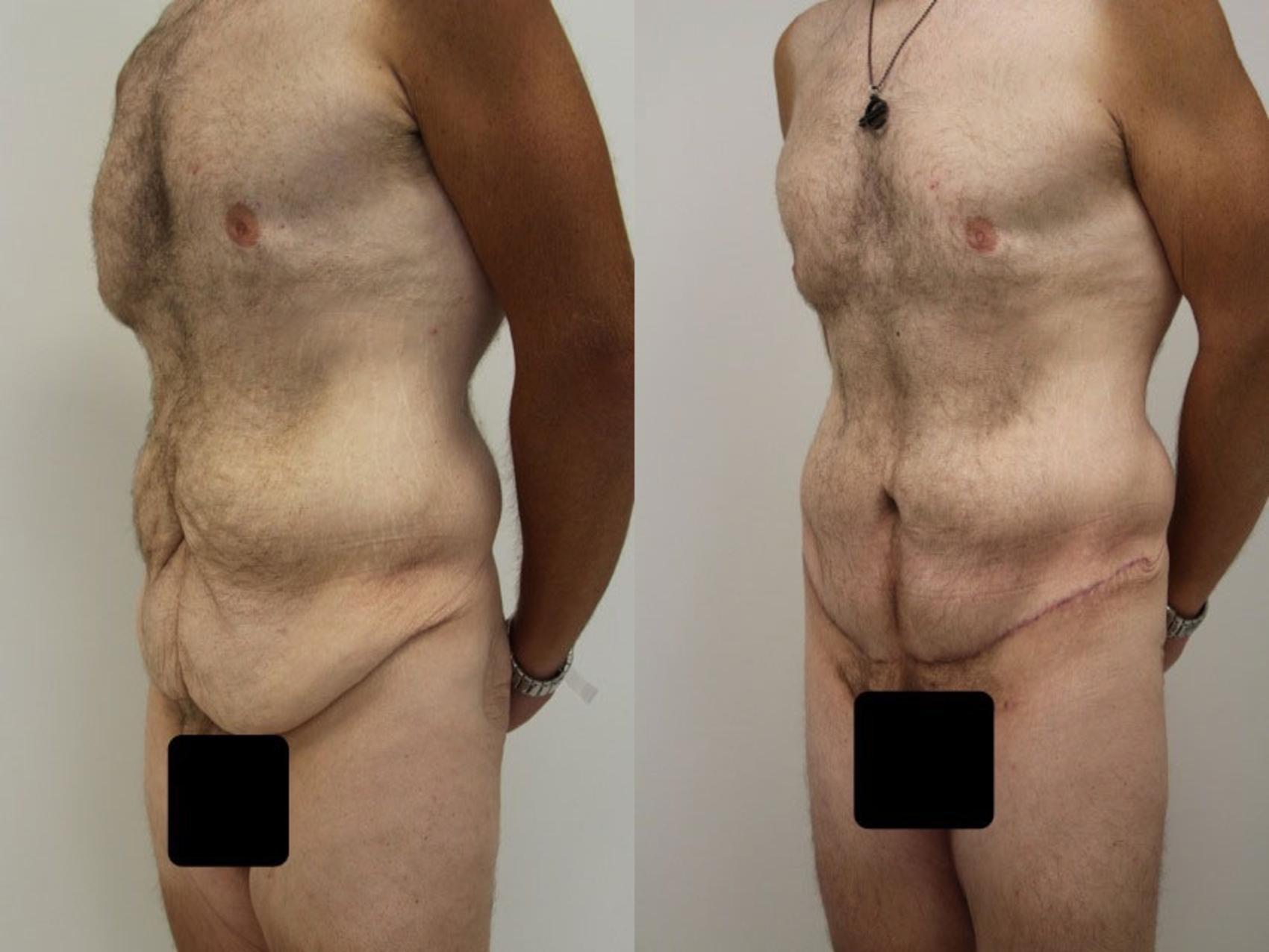 Before & After Abdominoplasty (Tummy Tuck) Case 46 View #2 View in Gilbert, AZ
