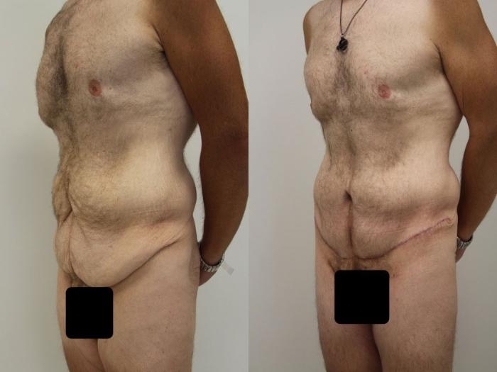 Before & After Tummy Tuck (Abdominoplasty) Case 46 View #2 View in Gilbert, AZ