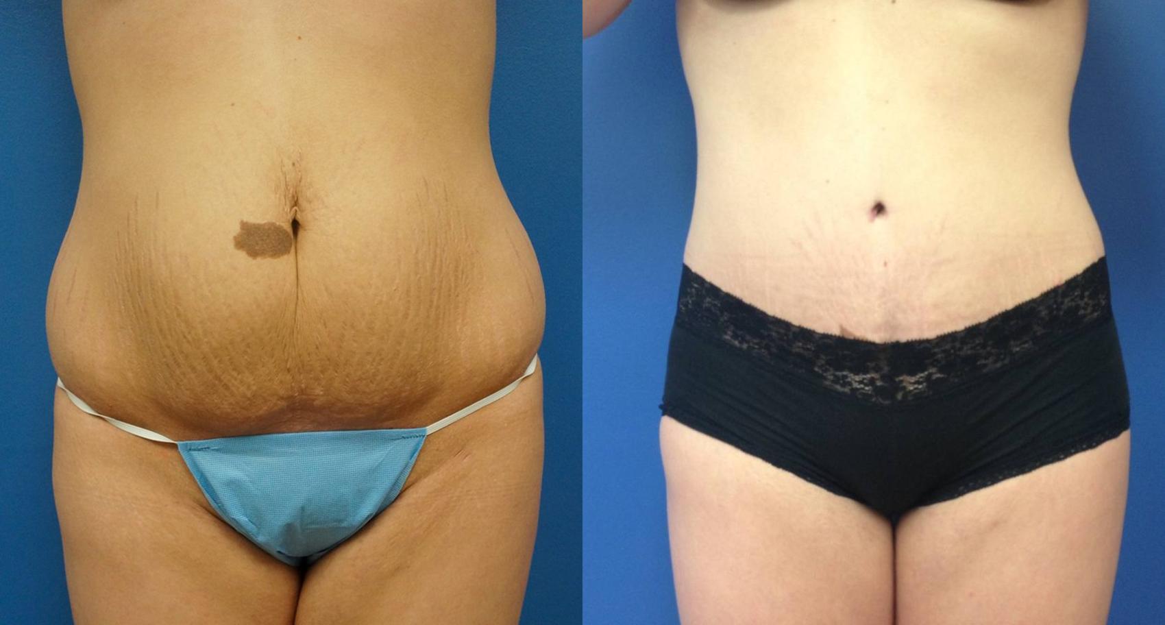 Before & After Tummy Tuck (Abdominoplasty) Case 5 View #1 View in Gilbert, AZ