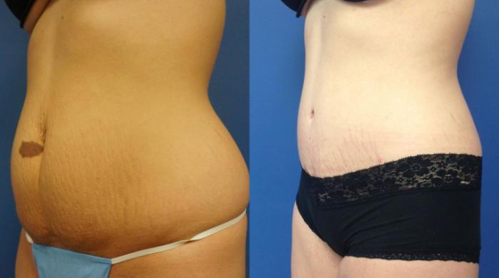 Before & After Tummy Tuck (Abdominoplasty) Case 5 View #2 View in Gilbert, AZ